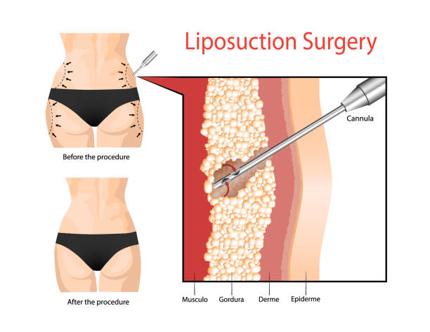 Liposuction Procedure